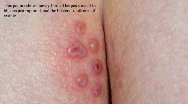 Herpes photos in different stages