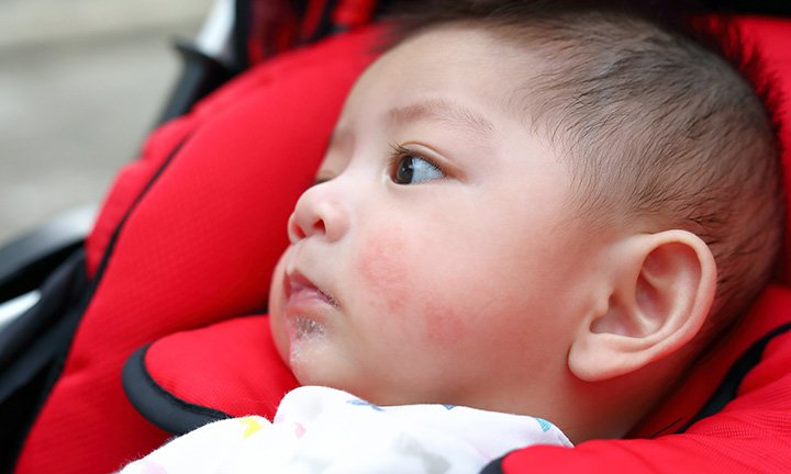 Teething Rash on Face